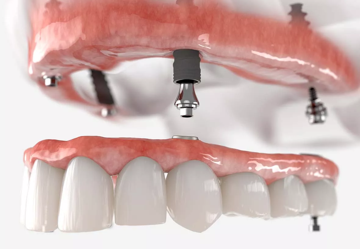 denture implants in Whitby