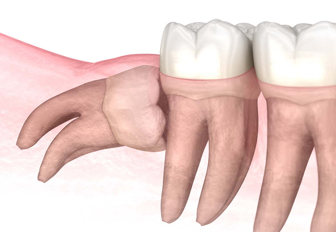wisdom teeth removal in Whitby